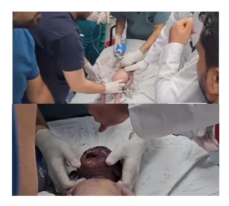 Doctors try to revive the baby