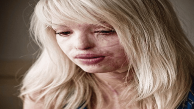 عارضة أزياء بعد 40 عملية تجميل watanserb.com