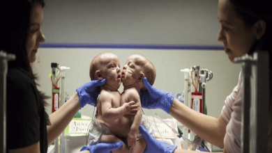 قلب وكبد مشترك لرضيعتين توأم watanserb.com