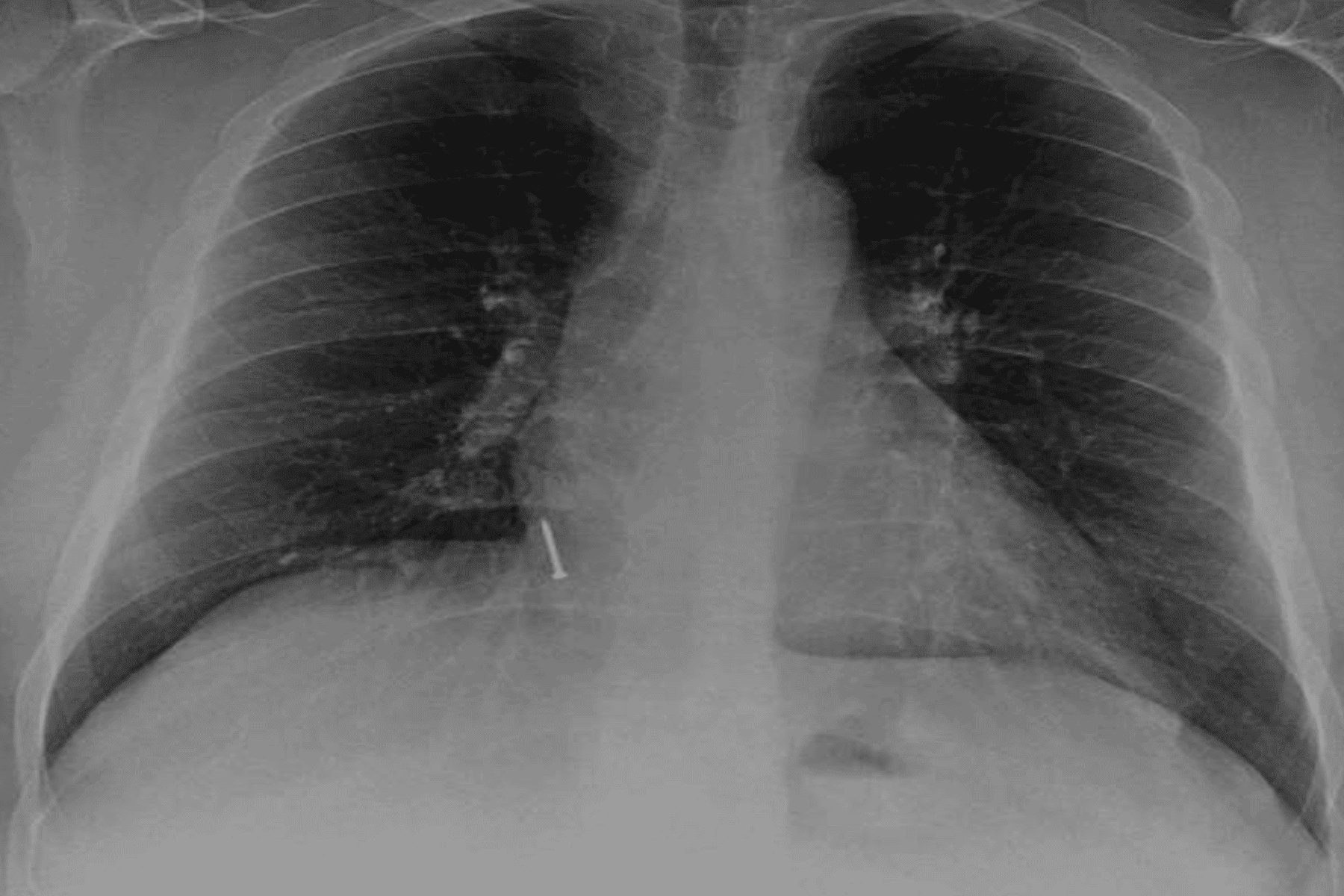 ابتلاع مسمار watanserb.com