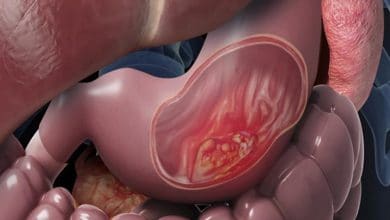 سرطان المعدة watanserb.com