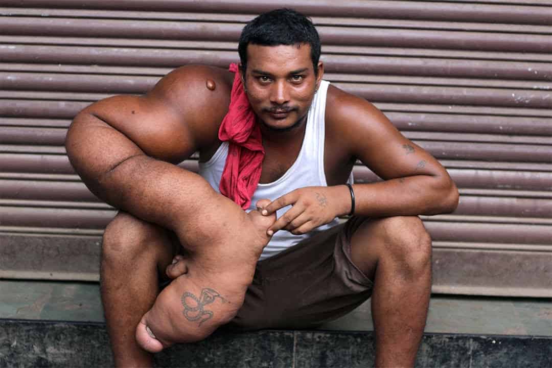 مرض جيني نادر يجعل يد هذا الشّاب تتعملق لحد لا يصدق!