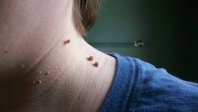 طريقة بسيطة جداً وسريعة للتخلص من الزّوائد الجلديّة