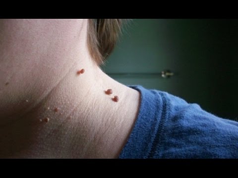 طريقة بسيطة جداً وسريعة للتخلص من الزّوائد الجلديّة