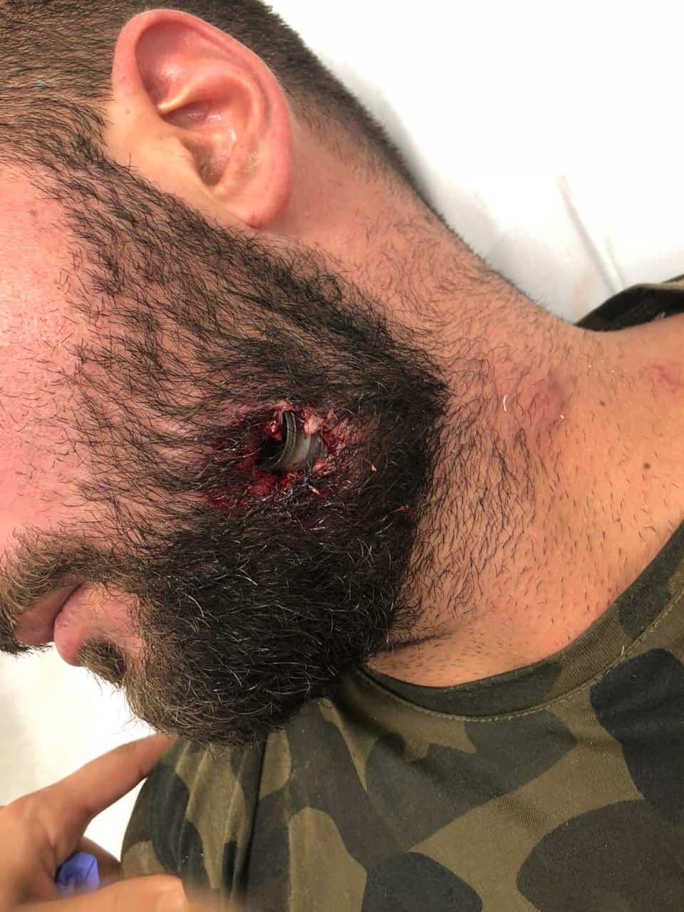 رصاصة مطاطية تخترق وجه متظاهر لبناني