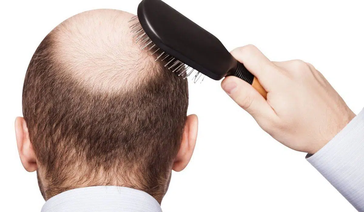 فيديو| وصفة طبيعية تخلصك من مشكلة تساقط الشعر نهائياً