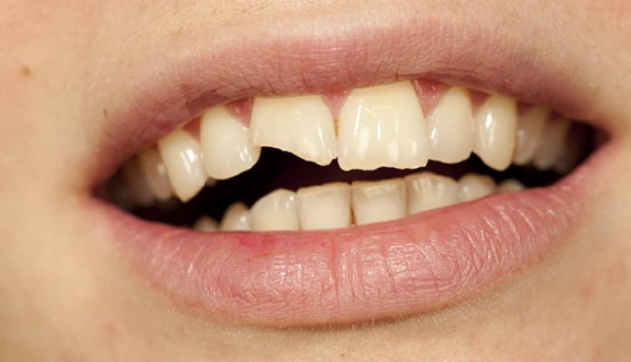 عادات سيئة تضر بأسنانك ويمكن أن تكسرها watanserb.com