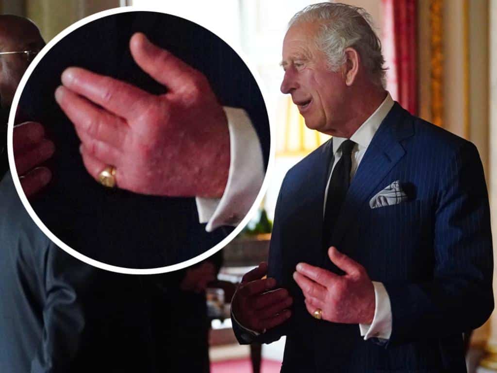 ما السبب وراء تورم أصابع الملك تشارلز الثالث؟ طبيب يجيب watanserb.com