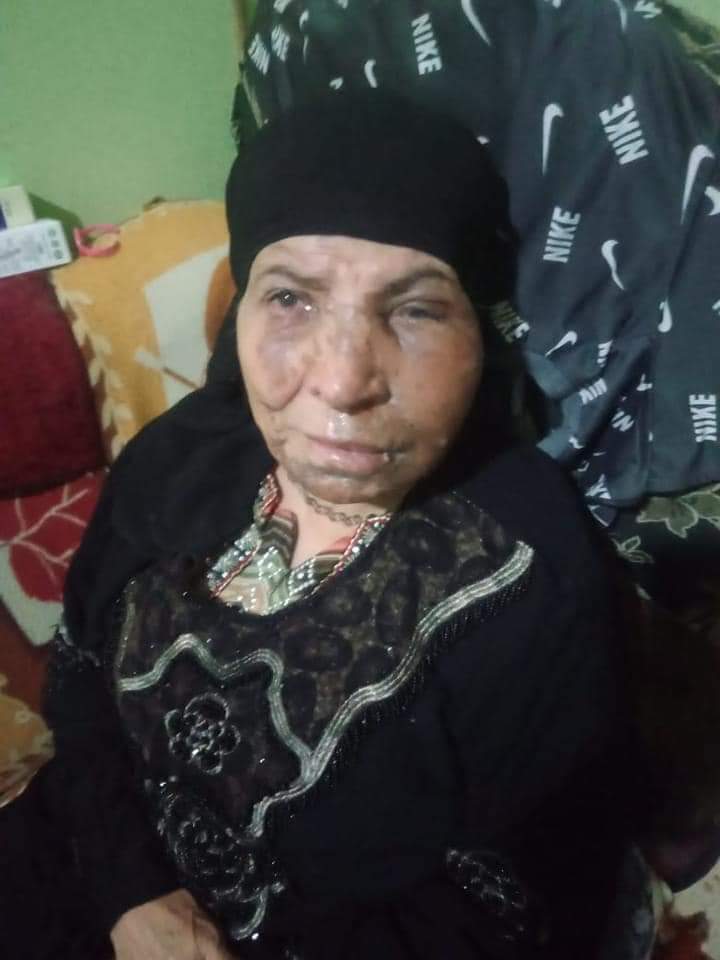 شاب مصري يشوه وجه فتاة بمادة حارقة لرفضها الزواج منه (صور ) 1