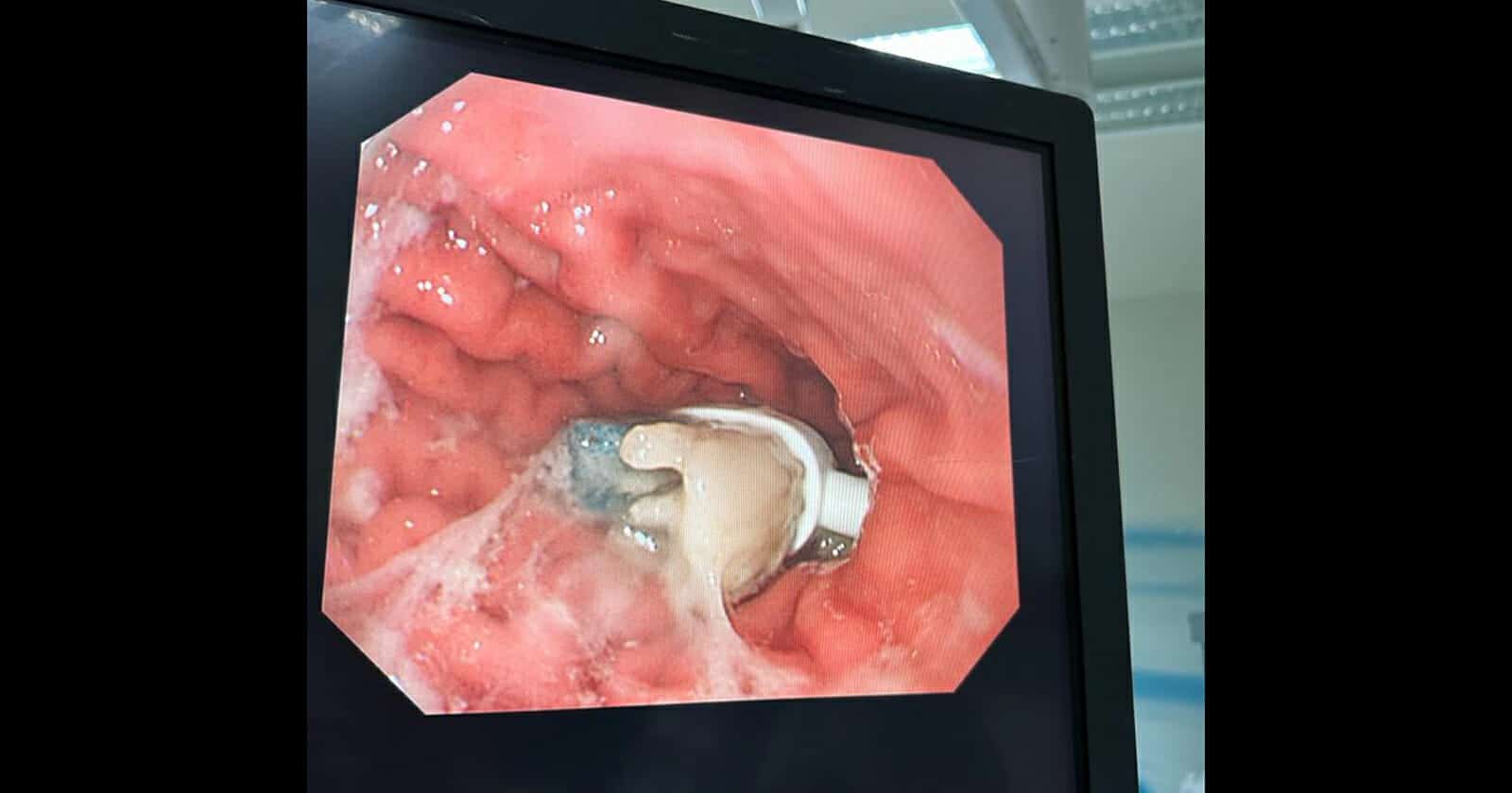 طفل سعودي ابتلع فرشاة أسنان watanserb.com