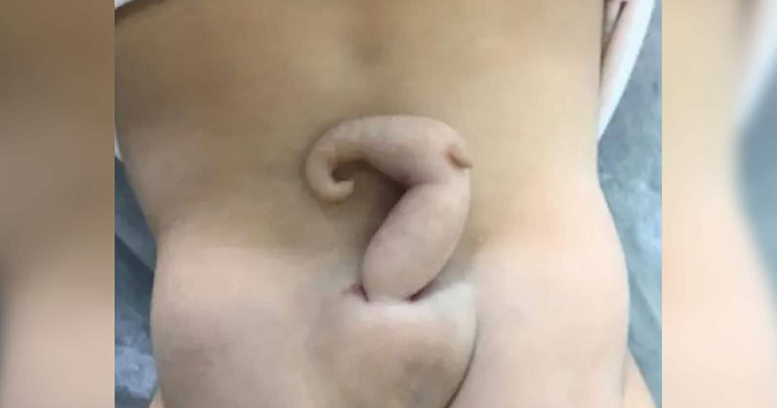 ولادة طفلة بذيل بشري watanserb.com