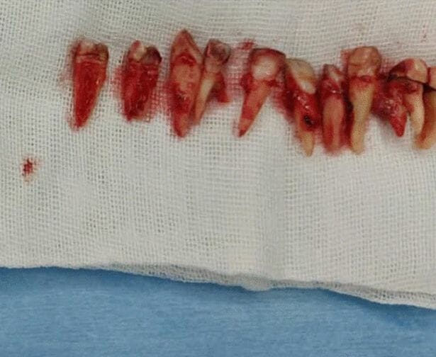 اضطر الأطباء إلى إزالة 12 من أسنان الرجل