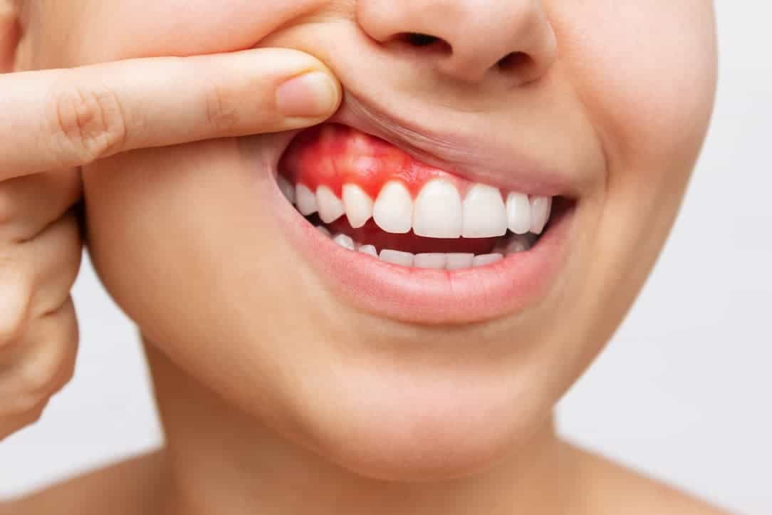 نزيف اللثة إحدى علامات سرطان الدم 