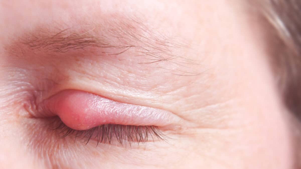 انتفاخ الجفون