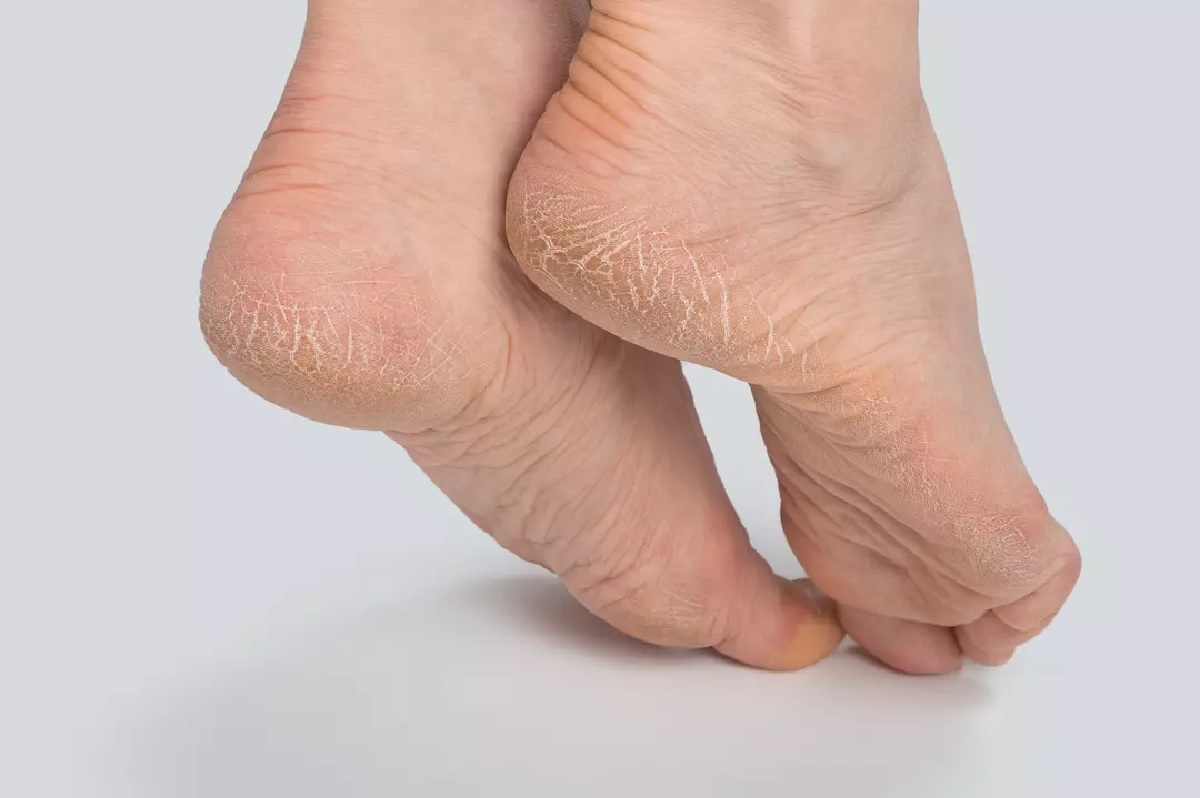 علاج الأقدام الجافة