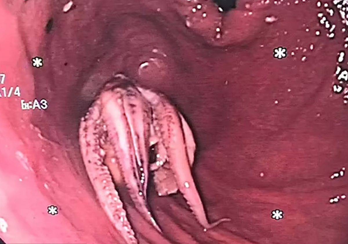 الصور الغريبة التي التقطتها أن الأخطبوط ، مكتملًا بماصاته ، عالقًا على بعد 5 سم من تقاطع المعدة والمريء