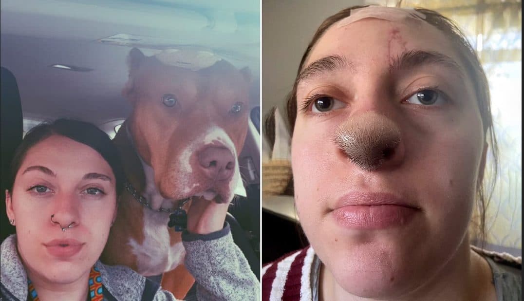 كيف تسببت عضة كلب في نمو شعر على وجه هذه الفتاة؟