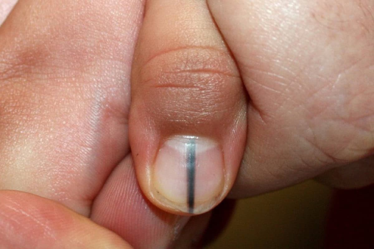 الخطوط السوداء على الأظافر