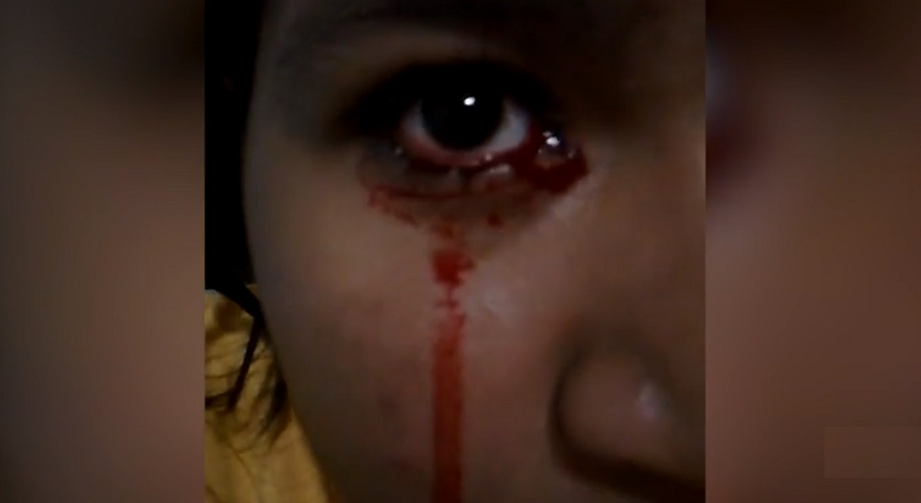فتاة كولومبية تبكي دموعاً من الدم في حالة مرضية تسمى الحيض البديل