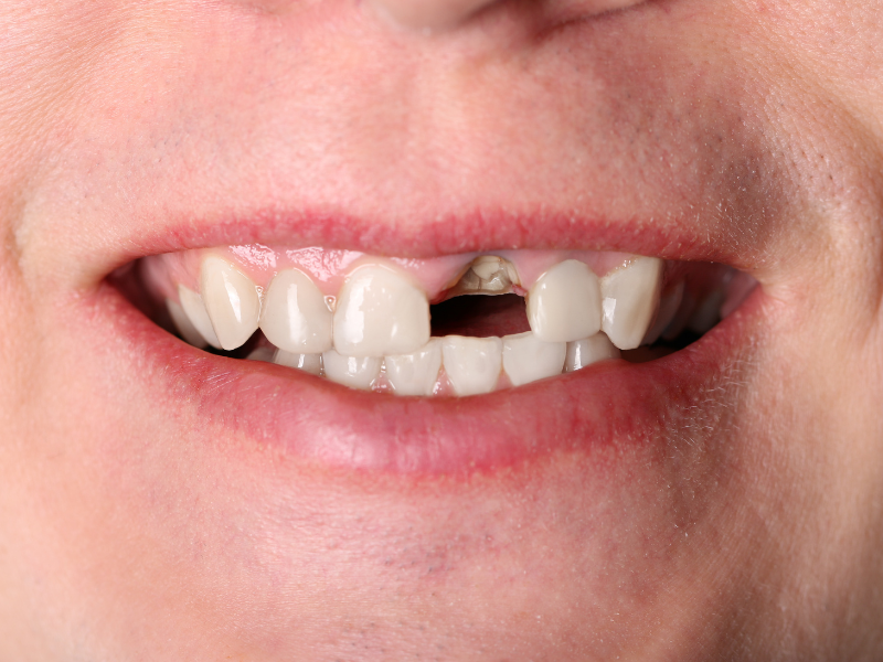 قد يكون تساقط الأسنان علامة على الإصابة بالسرطان ويجب عدم تجاهل الأمر