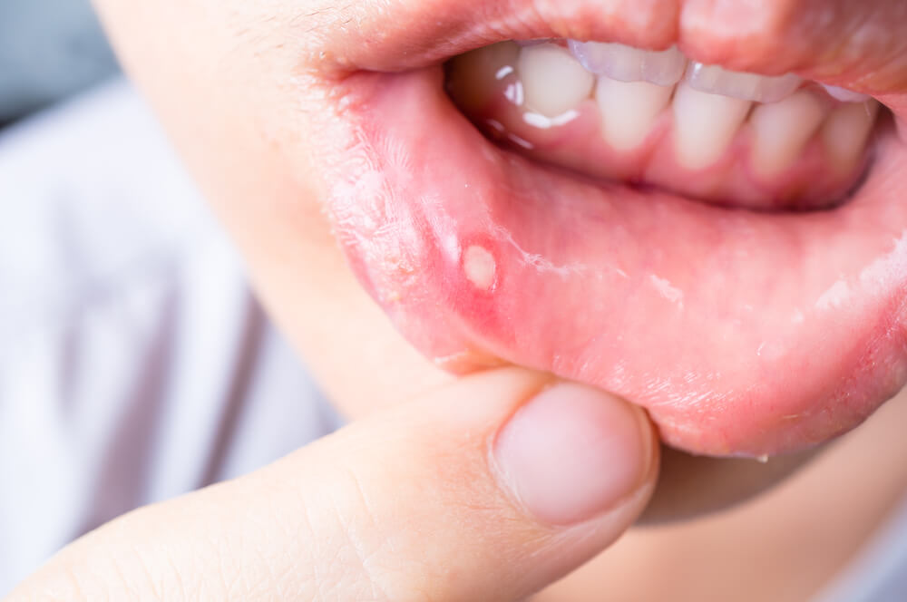 القرحة في الفم التي لا تشفى خلال ثلاثة أسابيع يمكن أن تكون علامة على الإصابة بسرطان الفم