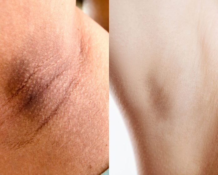 وصفات منزلية سحرية للقضاء على اسمرار المناطق الداكنة